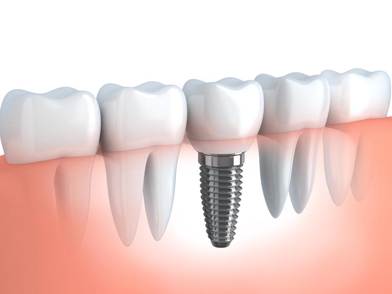 Dental Implants Chino, CA