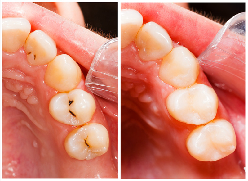 Fillings  Chino, CA 