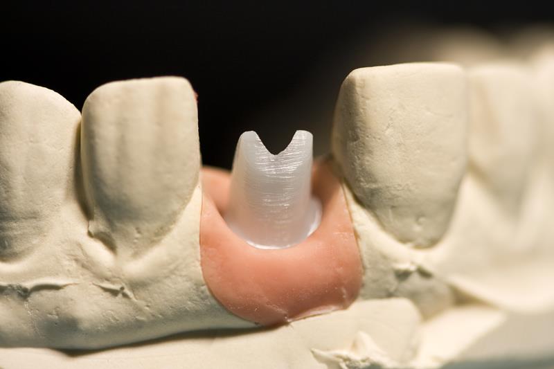Implant Restoration Chino, CA