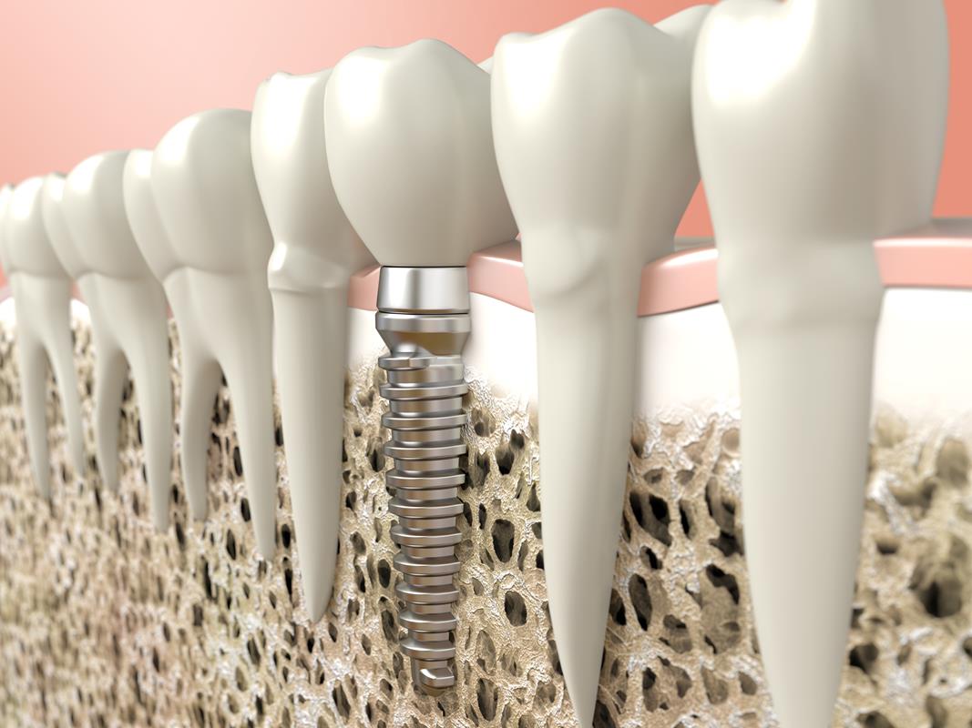 Dental Implants  Chino, CA 