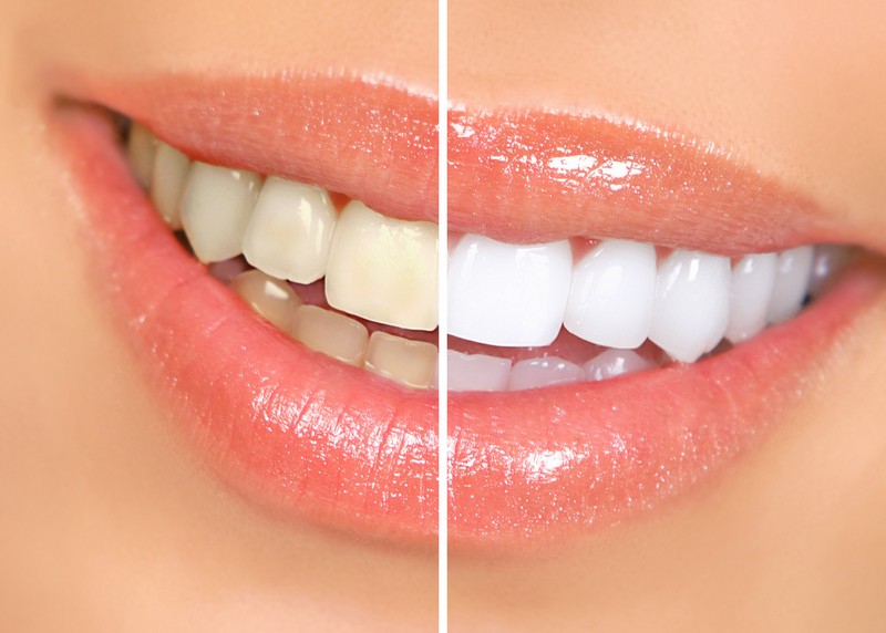 Teeth Whitening  Chino, CA 
